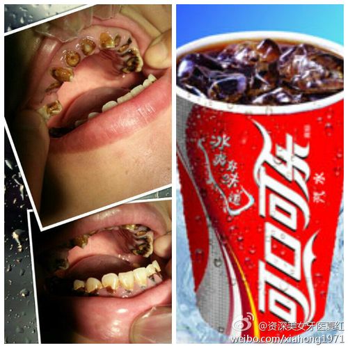 可乐牙的危害