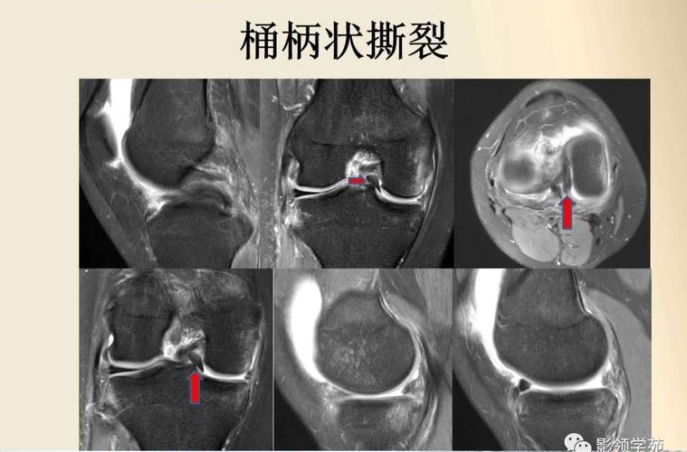 盘状半月板核磁