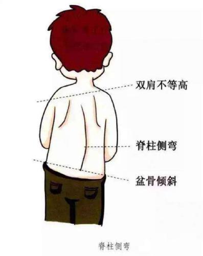孩子老是驼背耸肩,要小心是脊柱侧弯