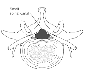 spinal stenosis (small spinal canal)
