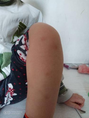 血小板低 四岁宝宝腿没磕没碰,突然出现淤青昨天是青色的今天变红了不