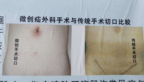 西峡县中医院开展经腹腔镜疝气修补术