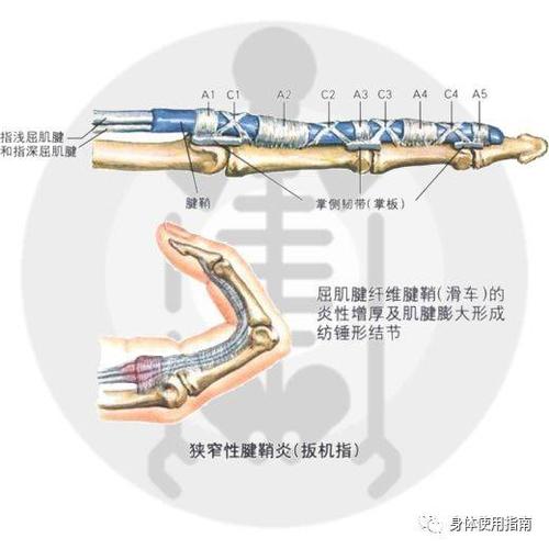 下图中蓝色部分为指屈肌腱鞘, a1-a5为滑车(腱鞘上的增厚部位), 滑车