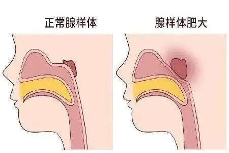 腺样体肥大手术费用成都民生耳鼻喉医院收费医保定点医院