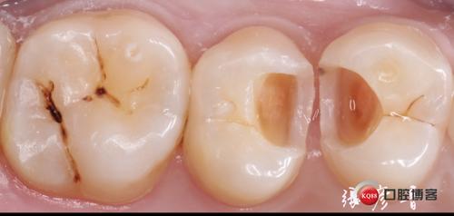 两例二类洞瓷嵌体修复