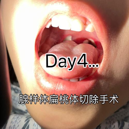 腺样体扁桃体手术恢复图可能引起不适慎点