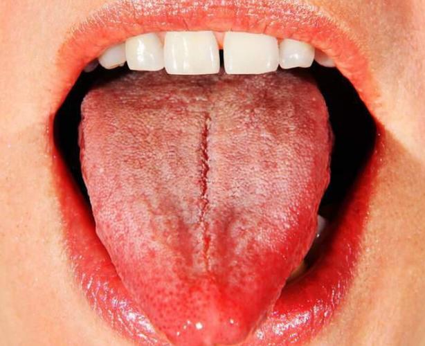 舌头有裂纹,齿痕是怎么回事?中医教你如何健康调理,不