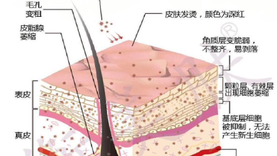 糖皮质激素依赖性皮炎