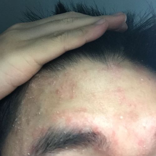 有人知道脸上出皮屑还有揉了会红肿是怎么回事吗?