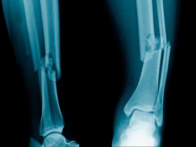 粉碎性骨折和普通骨折的区别是什么