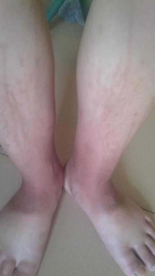 脚背出现大面积红色且痒