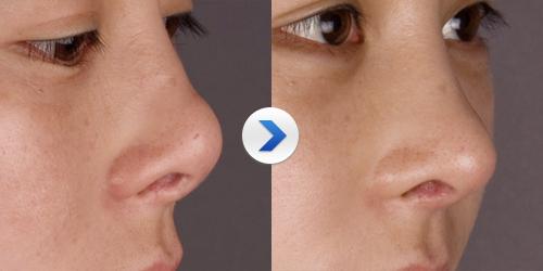 朝天鼻矫正需要的费用大概是多少