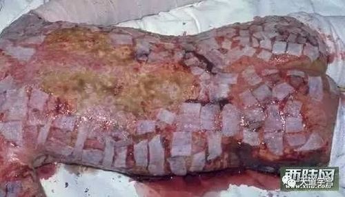 我们再来看一个案例,1998年日本东海村核临界事故的受害者大内久先生