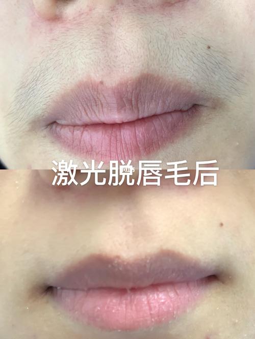 激光冰点无痛脱唇毛_脱唇毛_激光脱毛_小仙女_美妆_医