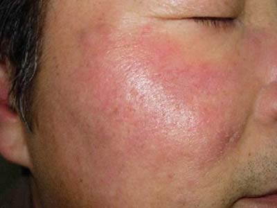 患日光性皮炎要怎么办