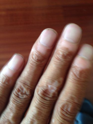 我手指甲盖后面发白是怎么了?有4,5年了.谢谢