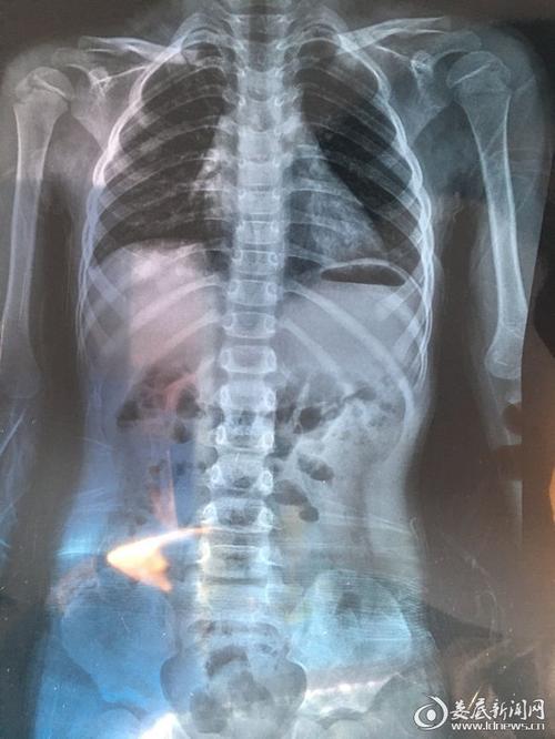 娄底医生三法施治脊柱侧弯女童挺直腰板