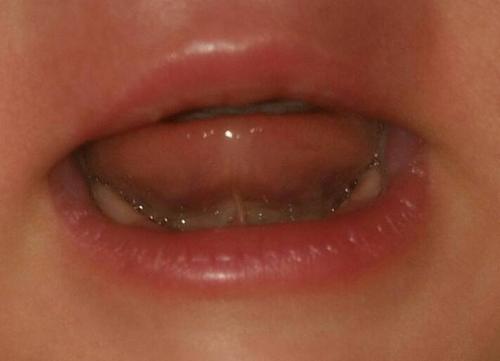 四个月婴儿两边牙龈发黄发白