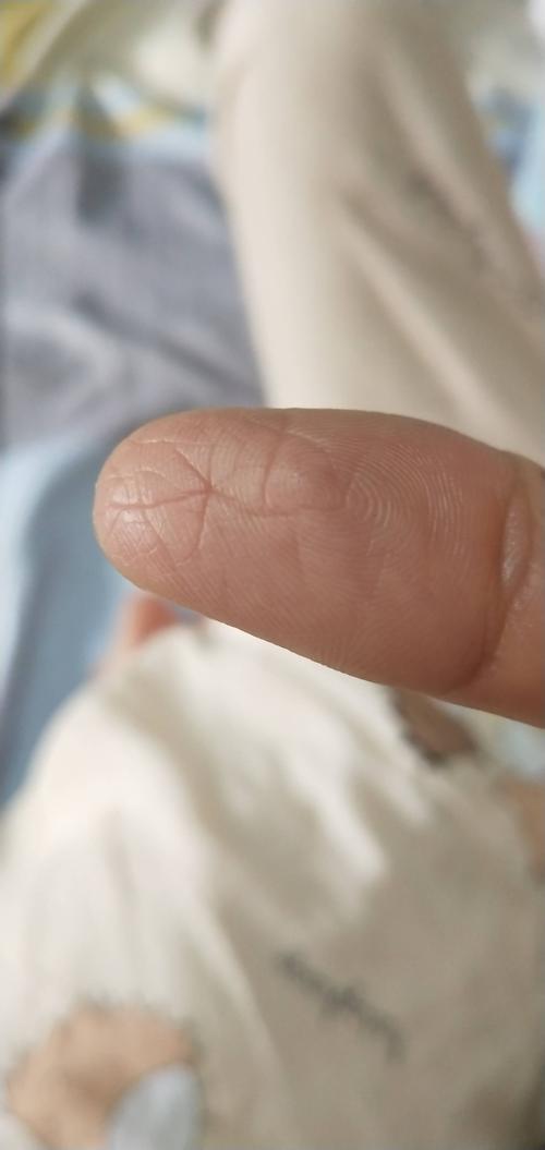 为什么手指头突然像这样有裂缝了搞不懂