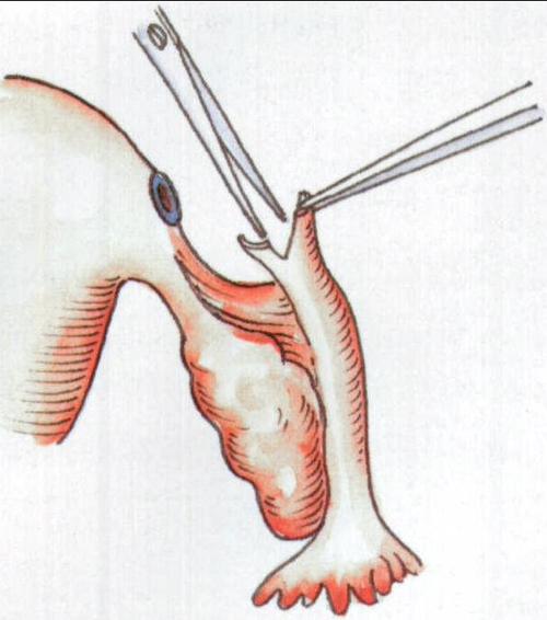 输卵管结扎术后复通术