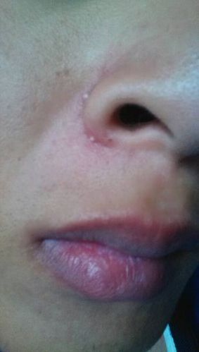 鼻子旁边经常长这样的白头是怎么回事?