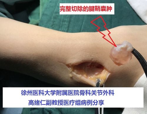 腕关节包块腱鞘囊肿怎么治疗一定要手术切除吗如何手术