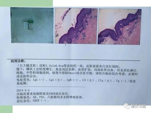 自从沙利度胺应用于风湿免疫病,它使以前很难控制的白塞病口腔溃疡