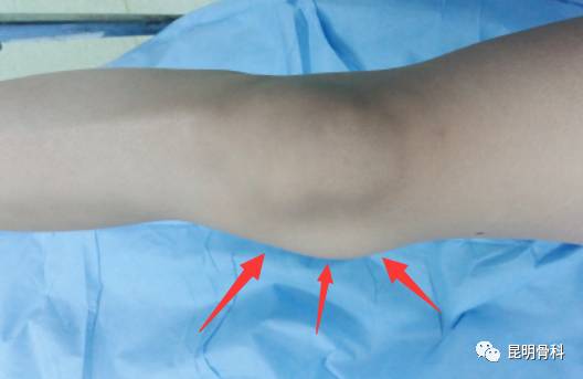 女患者膝盖长出鸡蛋大囊肿,昆骨医生:或与长期深蹲有关