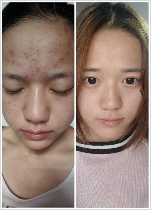 【分享贴】两年战痘心路历程,为你揭秘祛痘的终极奥秘