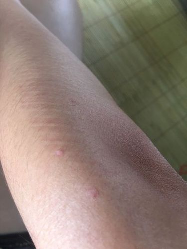 这是梅毒疹吗,只长在四肢上