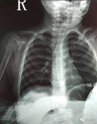 小儿锁骨青枝骨折一例