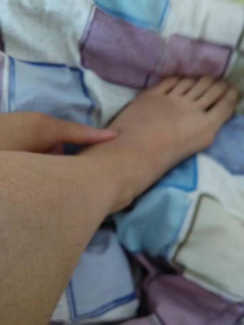 崴脚50小时,不疼能走不敢吃劲,左脚在侧脚面青了,微肿,刚崴时可持重