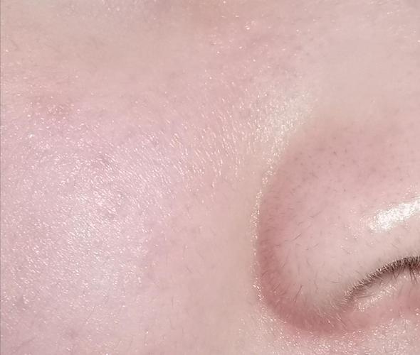 时隔很久的更新慎入鼻子两侧的小黑毛是什么啊能处理掉吗