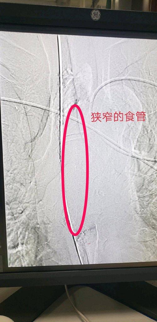 带你了解---食管狭窄支架置入术