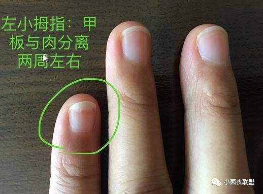 这两个药物是目前外用治疗灰指甲比较好的药物,但不好意思,国内暂时没