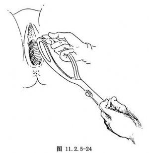产钳术 词条正文 放置左前叶产钳:术者先用右手握左叶产钳的钳匙(图11