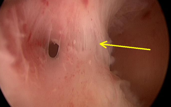 宫腔粘连会影响生育吗?该如何处理?