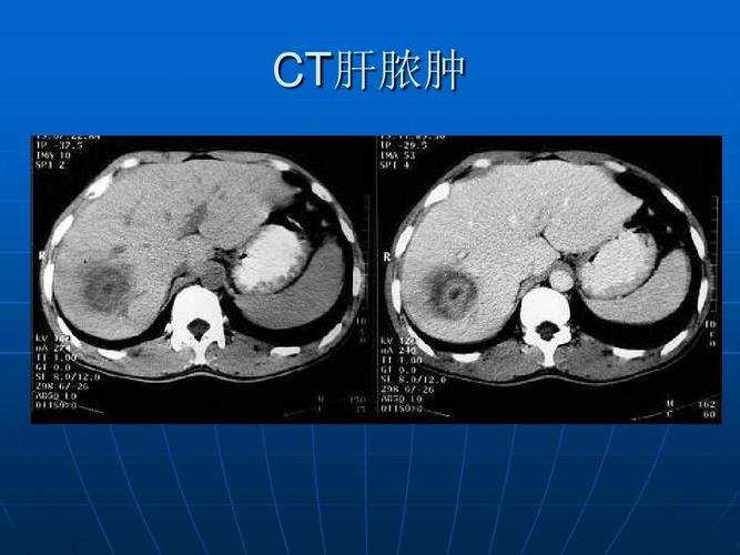 医学影像学上腹部ctppt