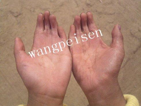 畸形的"鹅掌手"