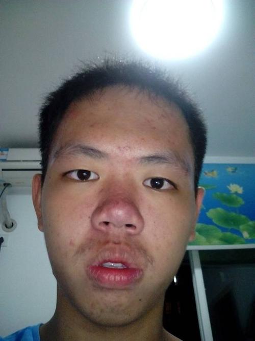 鼻子红红的,去医院看过,说是什么酒渣鼻.要怎么办?有3