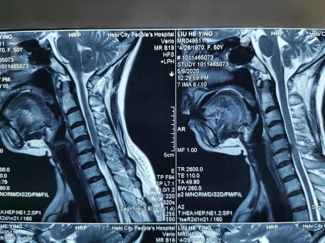 颈椎病专题(三):带你了解外伤后的颈脊髓损伤