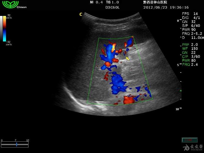 副脾- 超声医学讨论版 - 爱爱医医学论坛