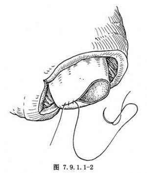 睾丸损伤睾丸修补缝合术