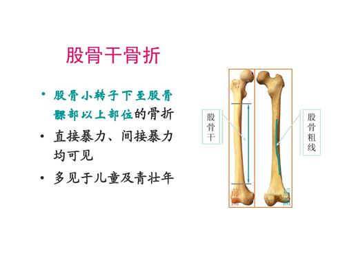 股骨干骨折ppt