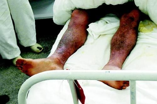 刑侦| 芥子气:这家伙可是"毒气之王"!