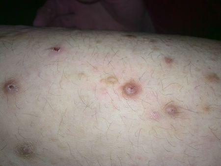 然后挠出的,可是回复之后就这样的疙瘩状请问是皮肤癌吗