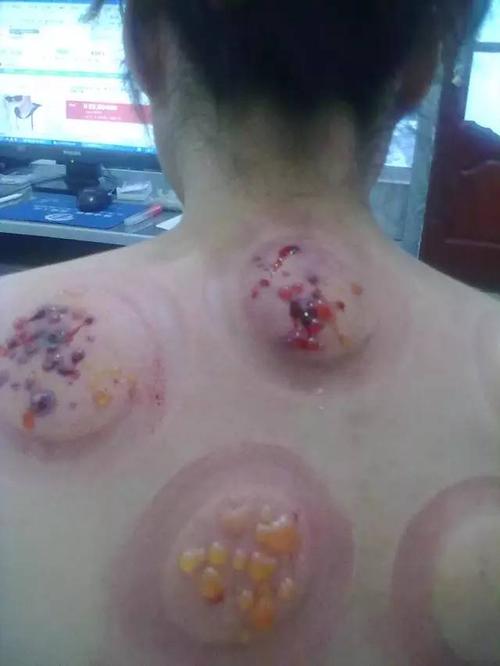 拔罐时为什么会有水泡血泡