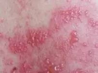 那些不典型的带状疱疹你中招了吗