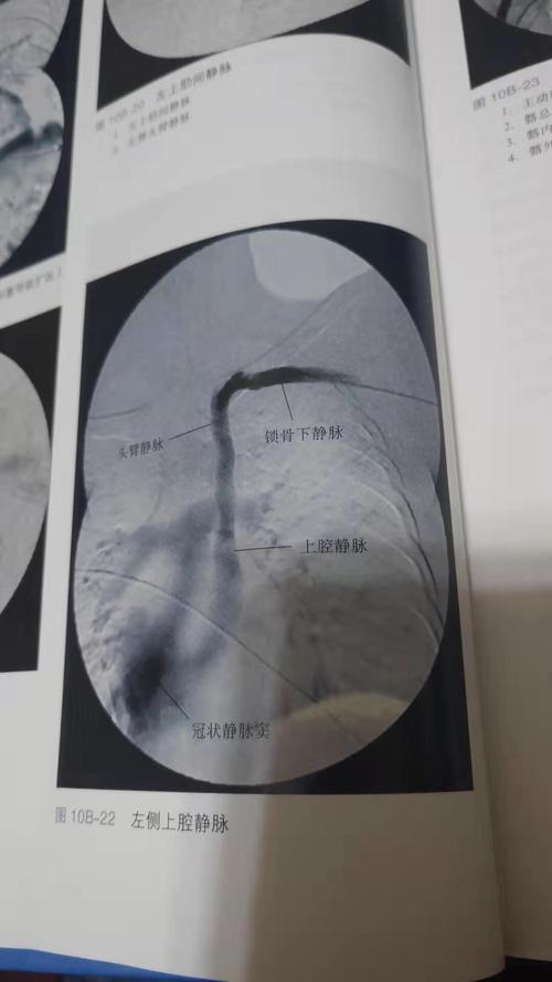 安乡县中医医院-永存左上腔静脉置管术