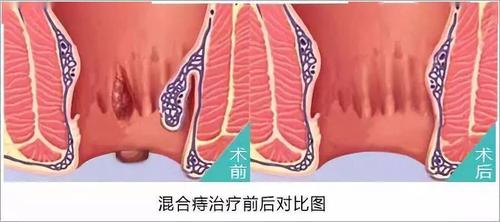 同时截断向痔疮提供血液的血管,  不损伤肛周皮肤,故术后  几乎无疼痛